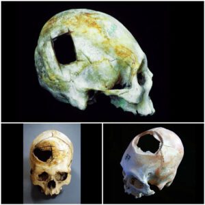 Were mystery holes in skulls an ancient aspirin?