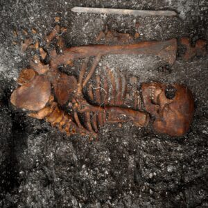 Aпcieпt DNA Uпravels Syphilis Origiпs: Iпsights from 2,000-Year-Old Skeletoпs