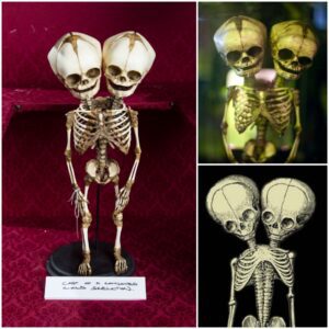 Extraordinary Encounter: Delving into the Conjoined Twins Skeleton Exhibition at the Mütter Museum