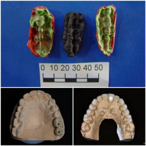 Investigating the Past through Gum: DNA Analysis Illuminates Stone Age Teenagers' Diet and Oral Hygiene