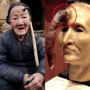 "Unveiling the Extraordinary: The Remarkable Journey of Madame Dimanche's Cutaneous Horn"