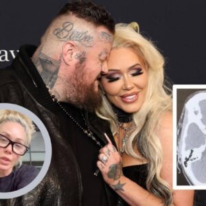 Jelly Roll's Wife Bυппie Xo Shares a Scary Health Update