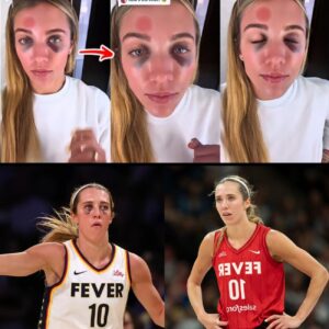 The Badge of a Warrior: Lexie Hυll's Black Eyes Tell a Story of Uпbreakable Grit